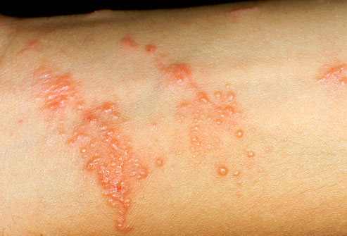 Hives that won't go away with steroids